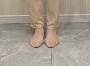 外反母趾の足